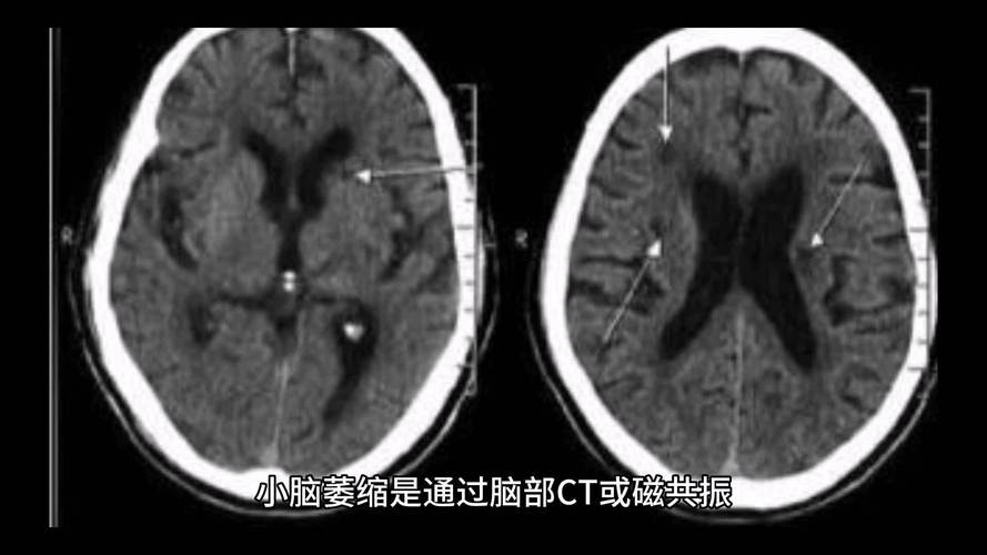 新澳门2025最新款免费和送小脑萎缩儿子高考与小脑萎缩能上学吗